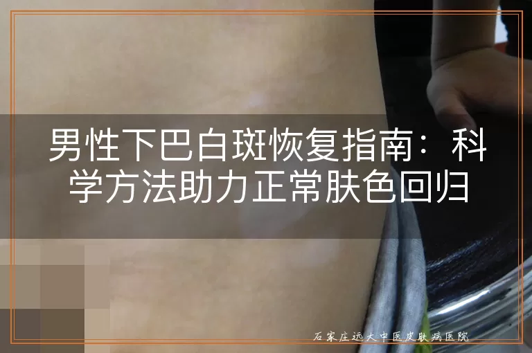 男性下巴白斑恢复指南：科学方法助力正常肤色回归