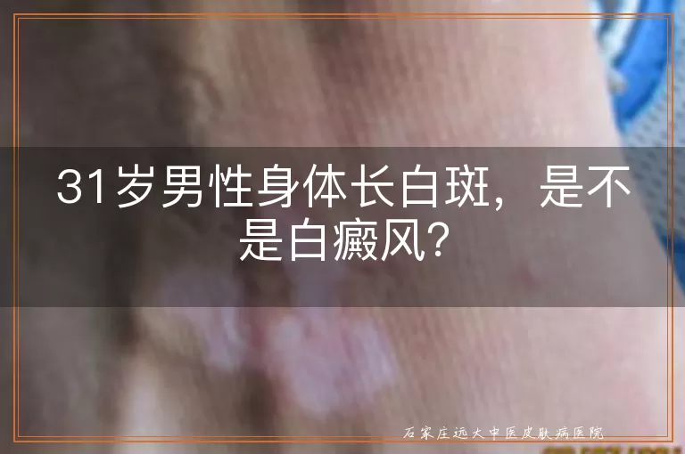 31岁男性身体长白斑,是不是白癜风?