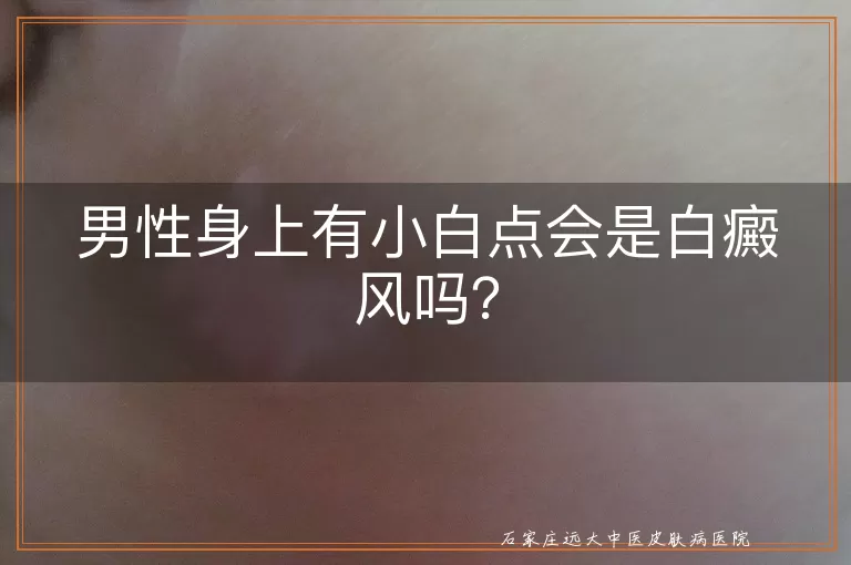 男性身上有小白点会是白癜风吗？