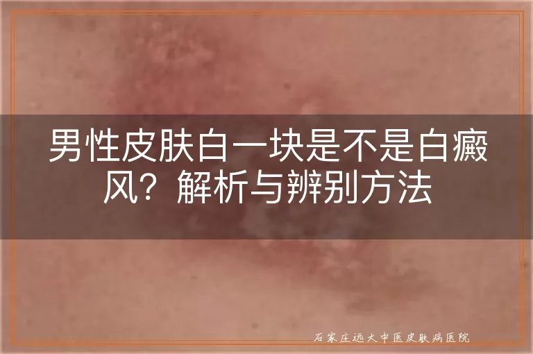 男性皮肤白一块是不是白癜风？解析与辨别方法