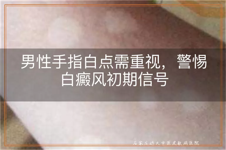 男性手指白点需重视，警惕白癜风初期信号