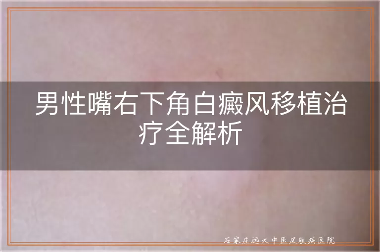 男性嘴右下角白癜风移植治疗全解析