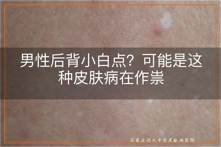 男性后背小白点？可能是这种皮肤病在作祟