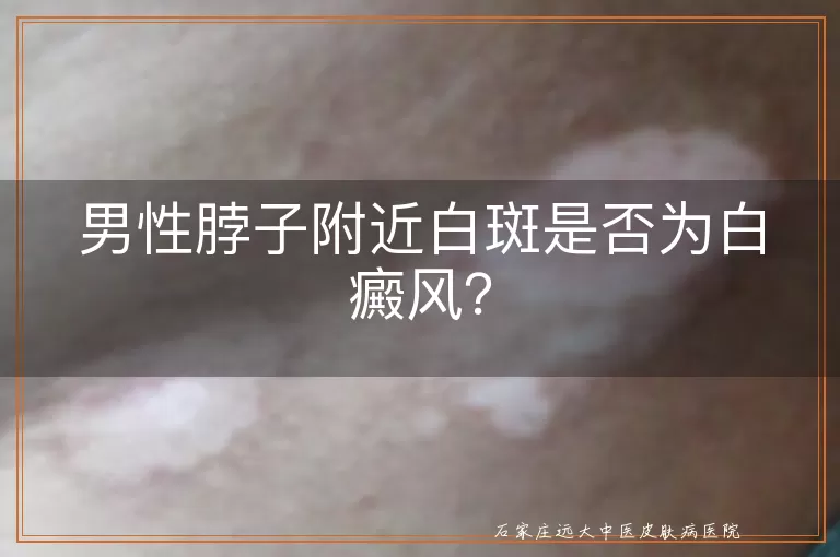 男性脖子附近白斑是否为白癜风？