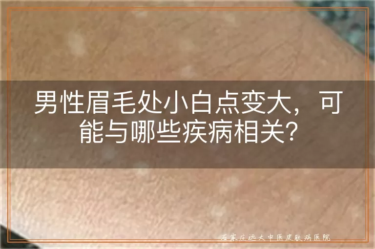 男性眉毛处小白点变大，可能与哪些疾病相关？