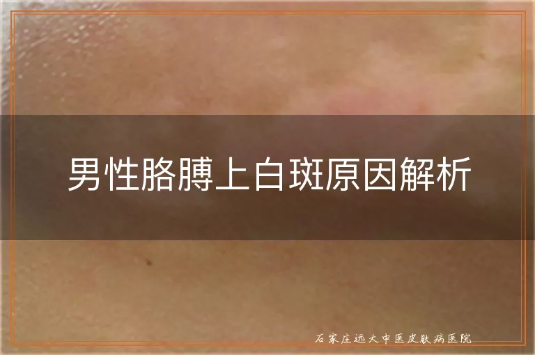 男性胳膊上白斑原因解析