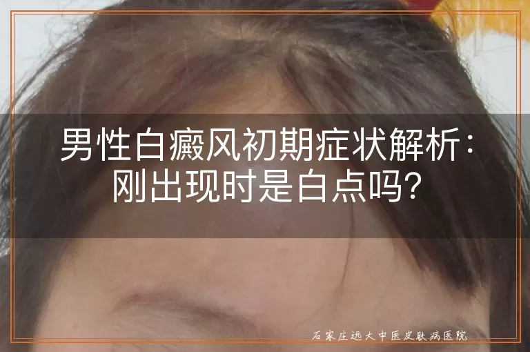 男性白癜风初期症状解析：刚出现时是白点吗？