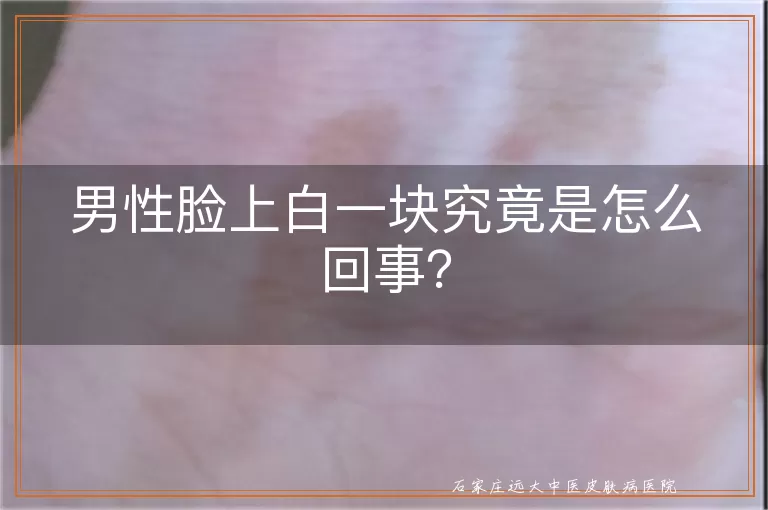 男性脸上白一块究竟是怎么回事？