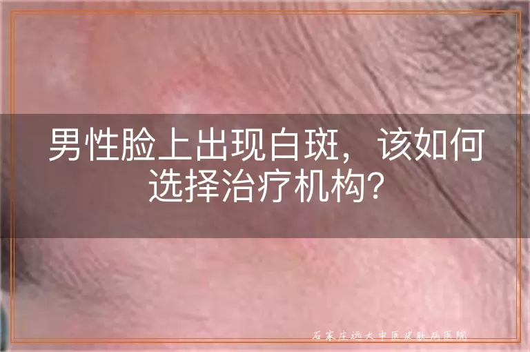 男性脸上出现白斑，该如何选择治疗机构？