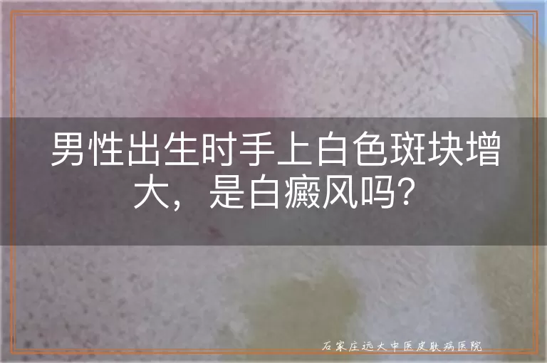 男性出生时手上白色斑块增大，是白癜风吗？