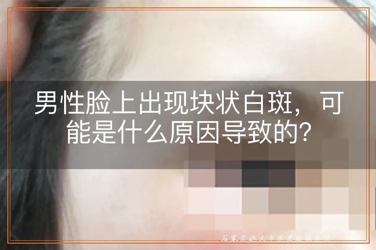 男性脸上出现块状白斑,可能是什么原因导致的?