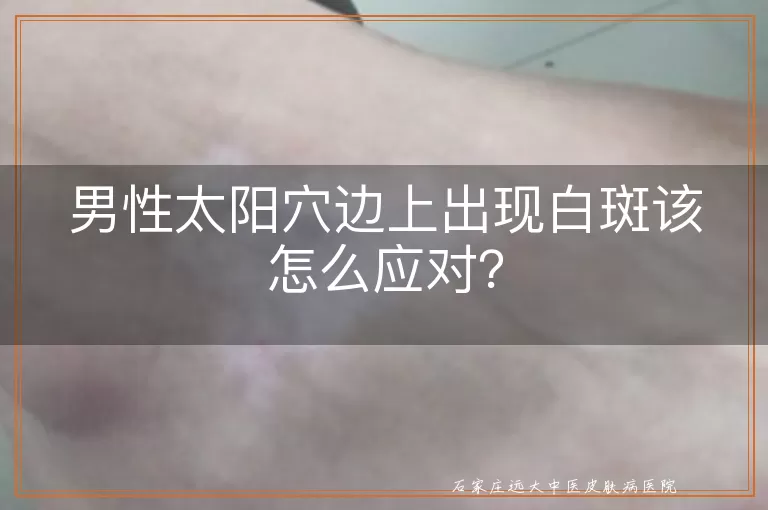 男性太阳穴边上出现白斑该怎么应对？