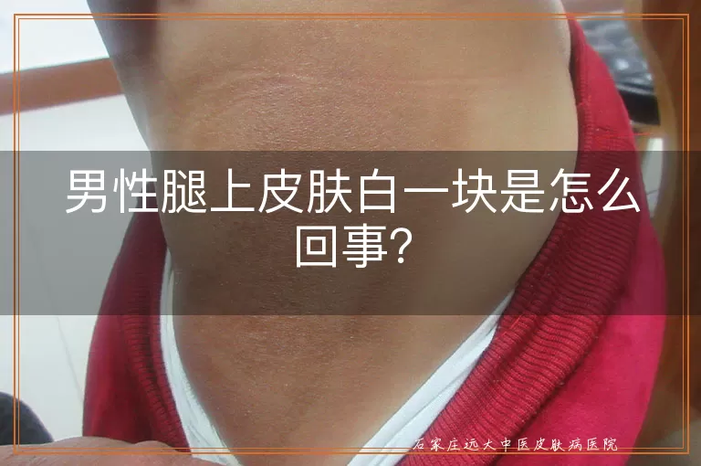 男性腿上皮肤白一块是怎么回事？
