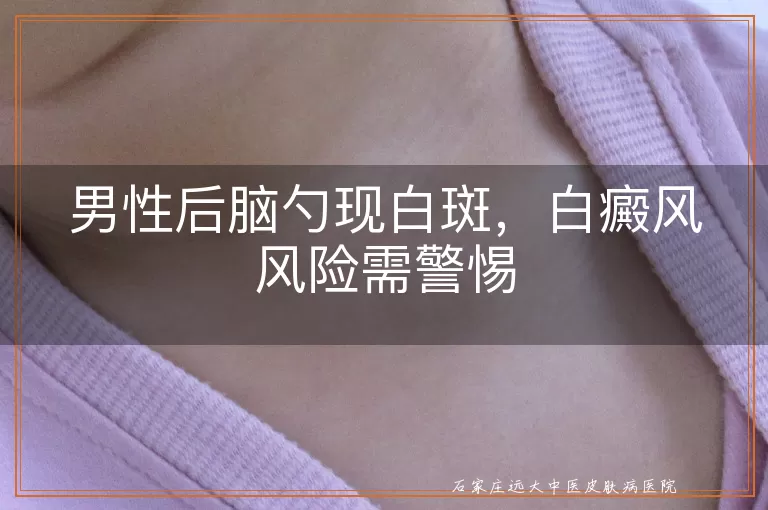 男性后脑勺现白斑,白癜风风险需警惕