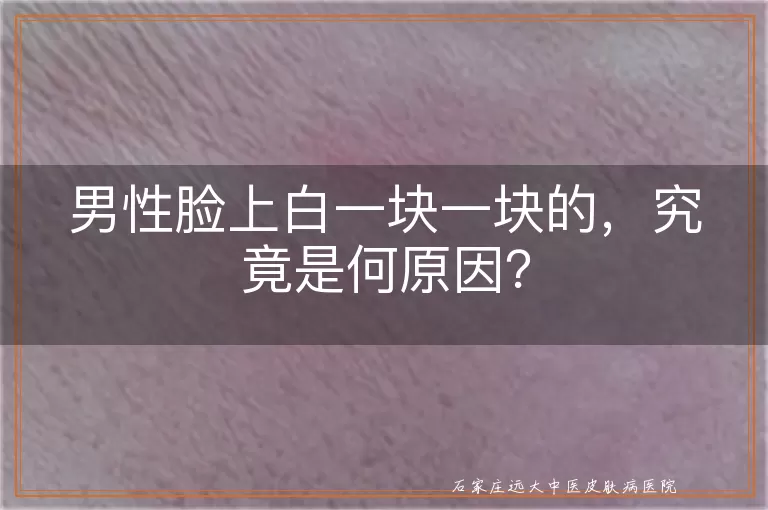 男性脸上白一块一块的，究竟是何原因？