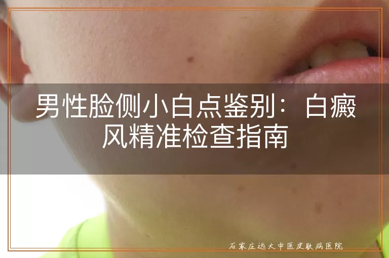 男性脸侧小白点鉴别:白癜风精准检查指南