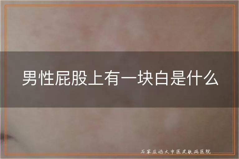 男性屁股上有一块白是什么