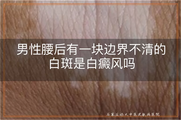 男性腰后有一块边界不清的白斑是白癜风吗