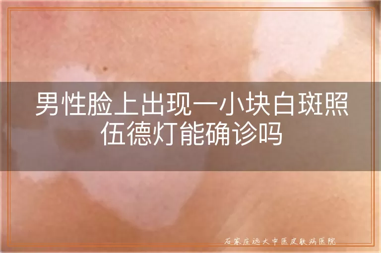 男性脸上出现一小块白斑照伍德灯能确诊吗