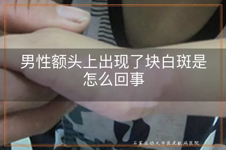 男性额头上出现了块白斑是怎么回事