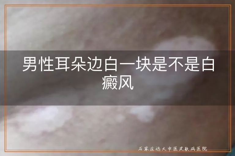 男性耳朵边白一块是不是白癜风