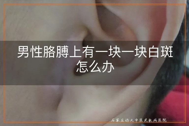 男性胳膊上有一块一块白斑怎么办