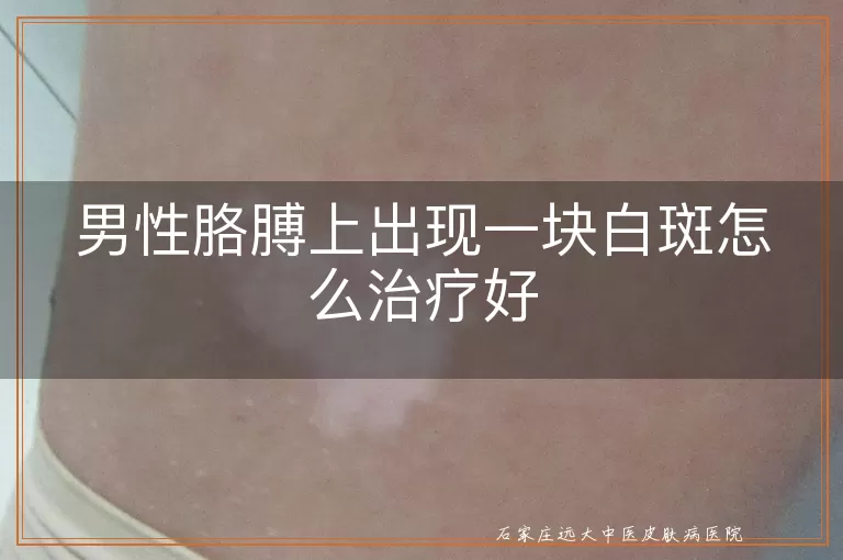 男性胳膊上出现一块白斑怎么治疗好