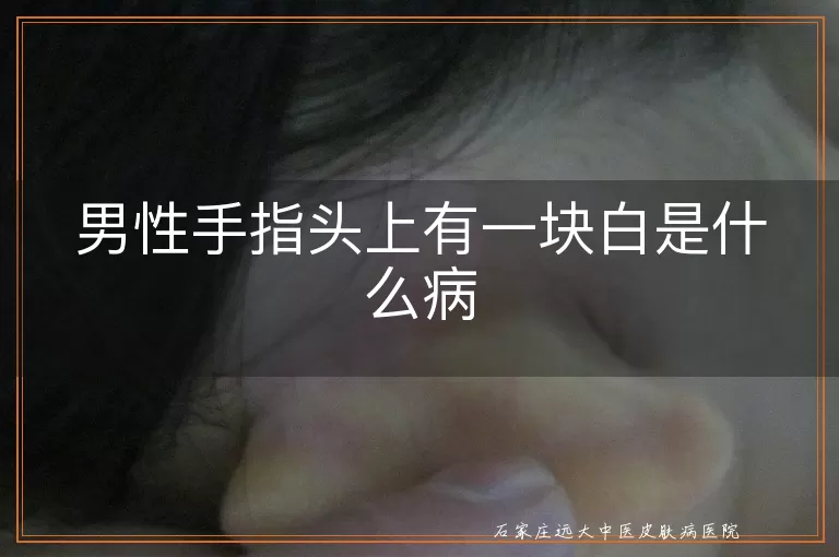 男性手指头上有一块白是什么病
