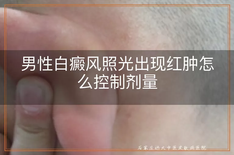 男性白癜风照光出现红肿怎么控制剂量