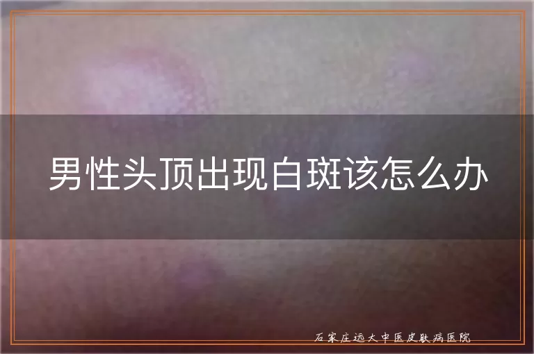 男性头顶出现白斑该怎么办