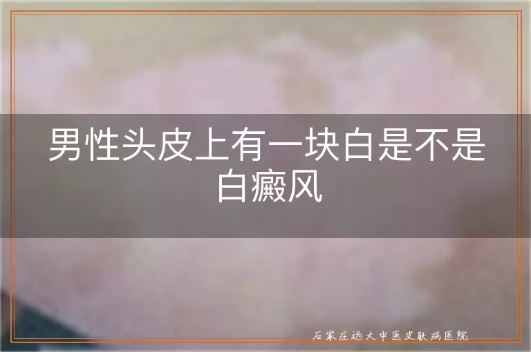 男性头皮上有一块白是不是白癜风