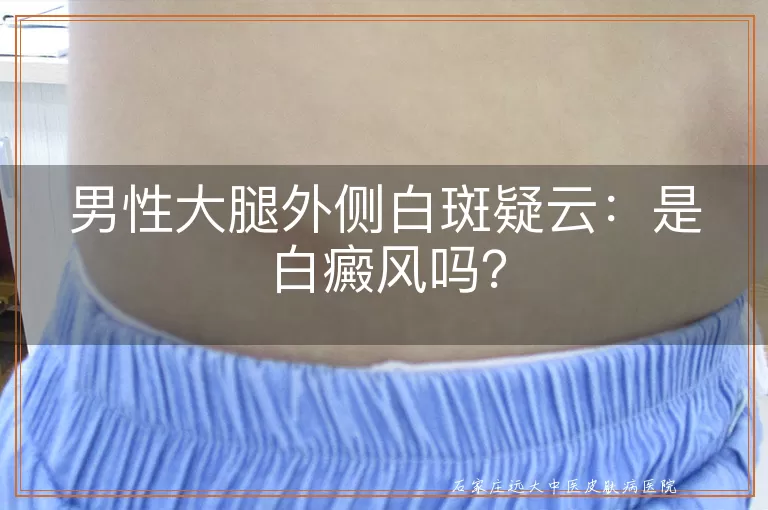 男性大腿外侧白斑疑云：是白癜风吗？