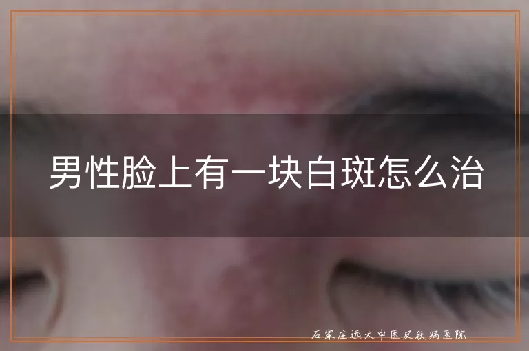 男性脸上有一块白斑怎么治