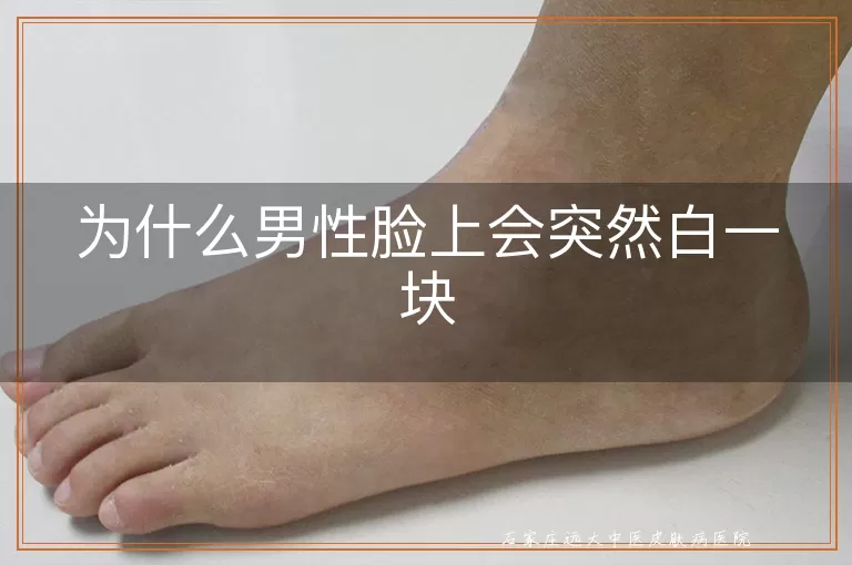 为什么男性脸上会突然白一块