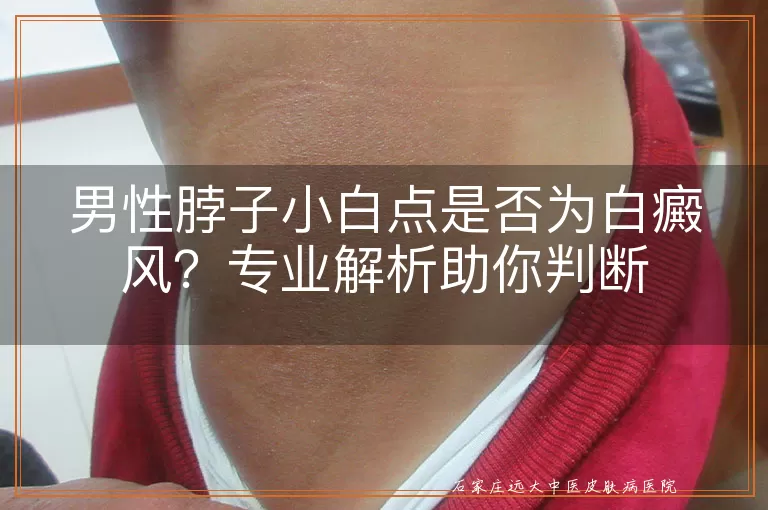 男性脖子小白点是否为白癜风？专业解析助你判断