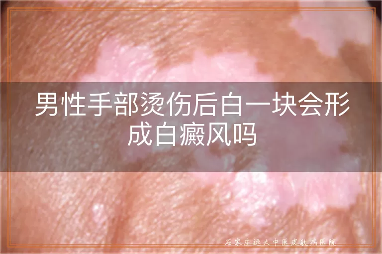 男性手部烫伤后白一块会形成白癜风吗