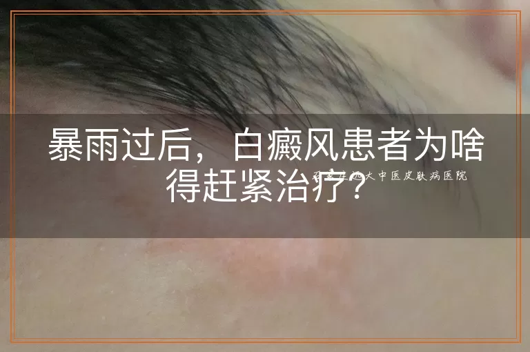 暴雨过后，白癜风患者为啥得赶紧治疗？