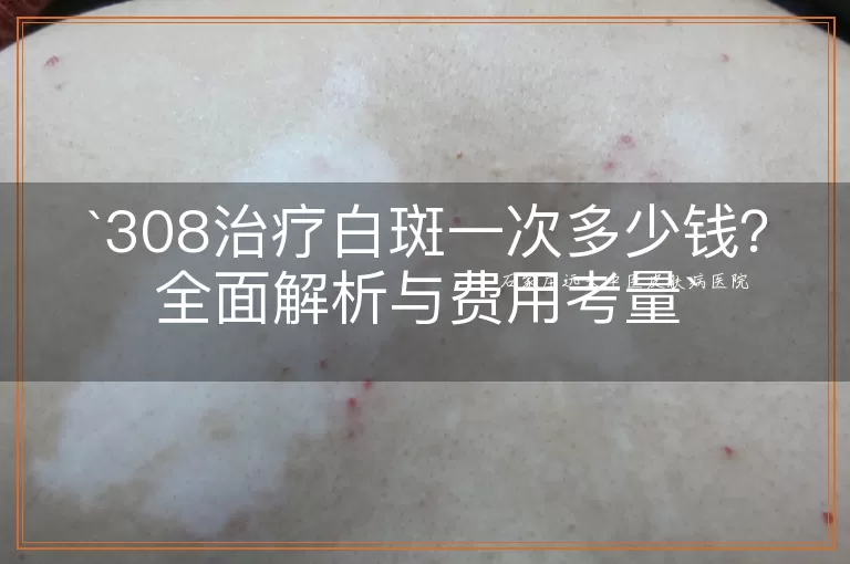 308治疗白斑一次多少钱?全面解析与费用考量
