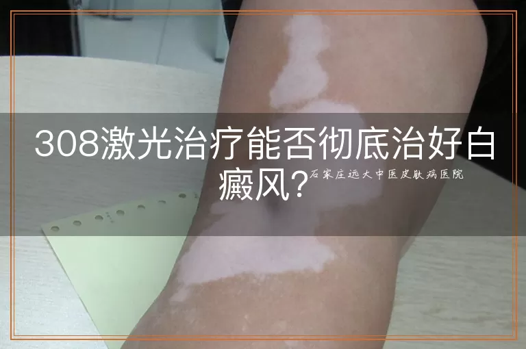 308激光治疗能否彻底治好白癜风？