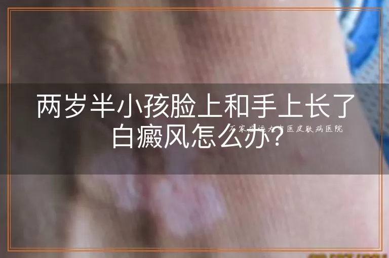 两岁半小孩脸上和手上长了白癜风怎么办?