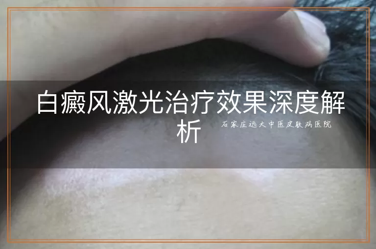 白癜风激光治疗效果深度解析
