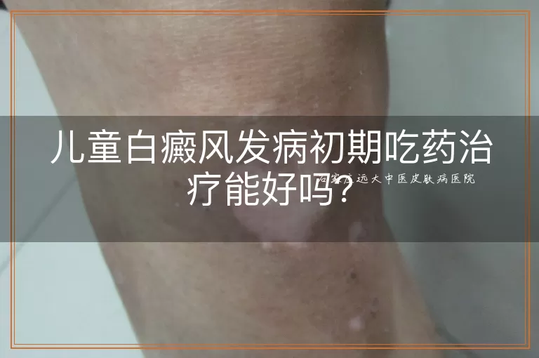 儿童白癜风发病初期吃药治疗能好吗？