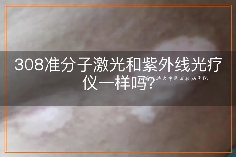 308准分子激光和紫外线光疗仪一样吗?