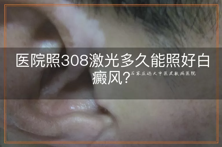 医院照308激光多久能照好白癜风？