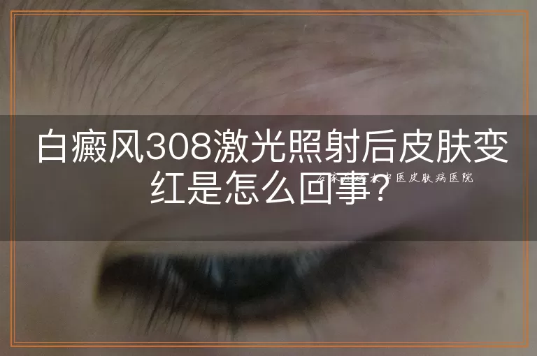 白癜风308激光照射后皮肤变红是怎么回事?