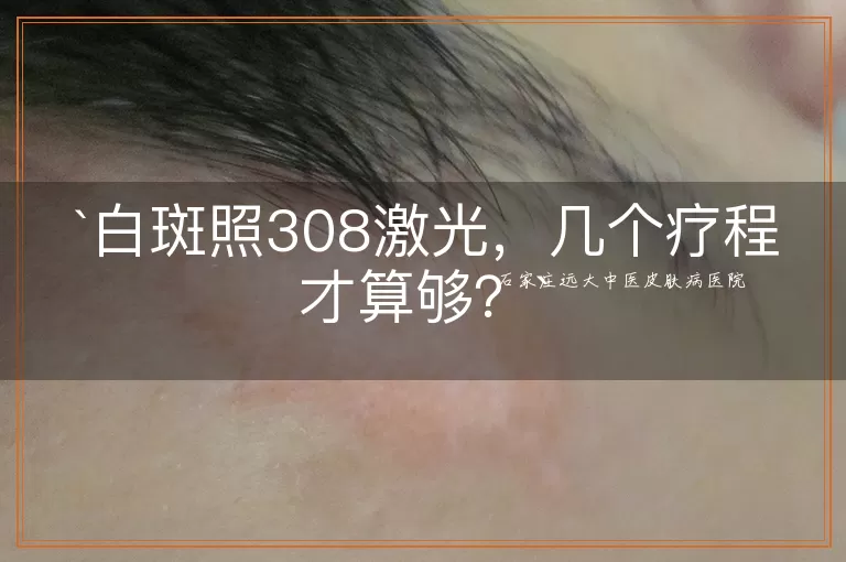 白斑照308激光，几个疗程才算够？