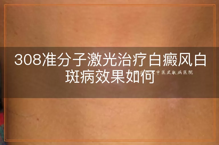 308准分子激光治疗白癜风白斑病效果如何