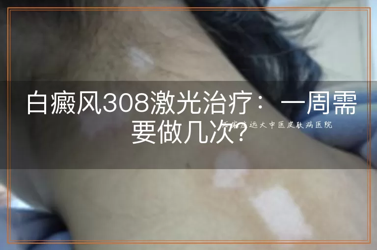 白癜风308激光治疗：一周需要做几次？