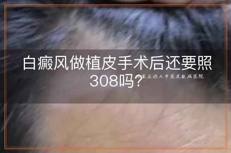 白癜风做植皮手术后还要照308吗？
