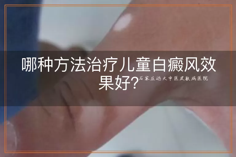 哪种方法治疗儿童白癜风效果好?